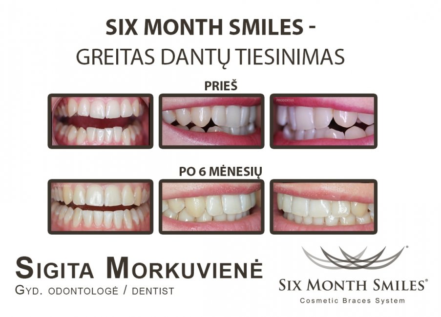 Six Month Smiles 
